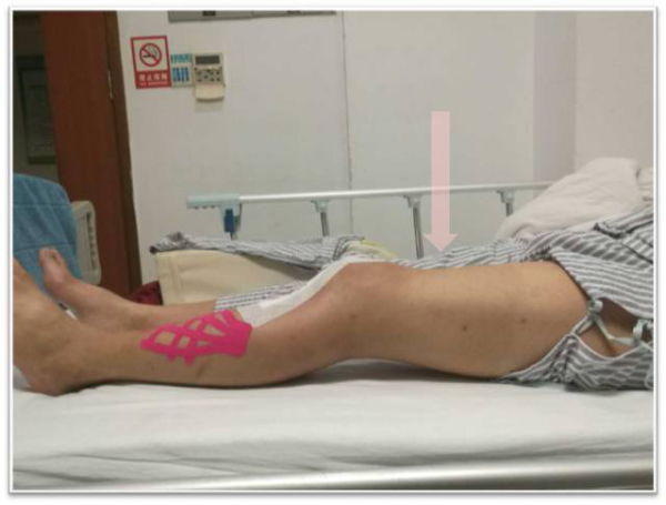 【康复科普】康复治疗是治疗而非锻炼！